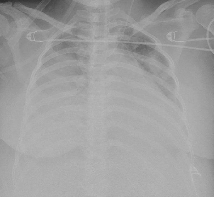 Hình ảnh tổn thương phổi nặng tại thời điểm can thiệp VV-ECMO